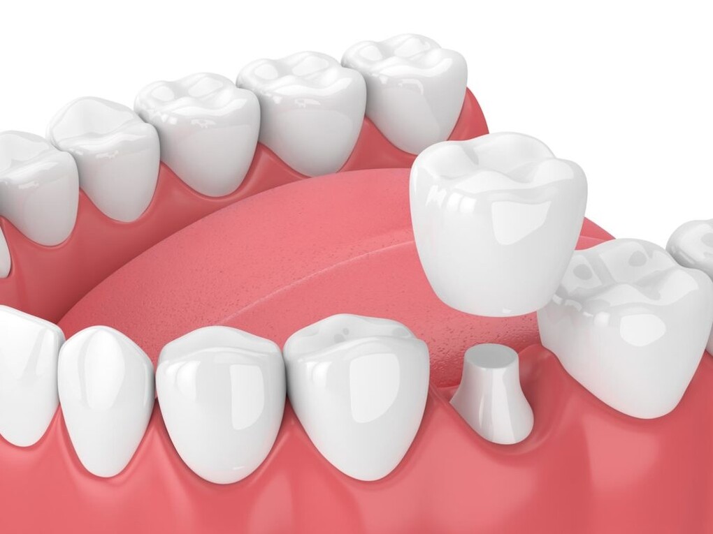 Саяногорск Инфо - Что из себя представляют коронки на зубы - tooth.jpg