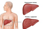 В Хакасии мать обрекла на смерть больную циррозом печени дочь