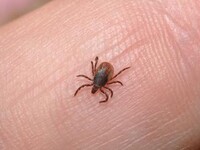 В Хакасии после укуса клещей дети заболели сибирским тифом
