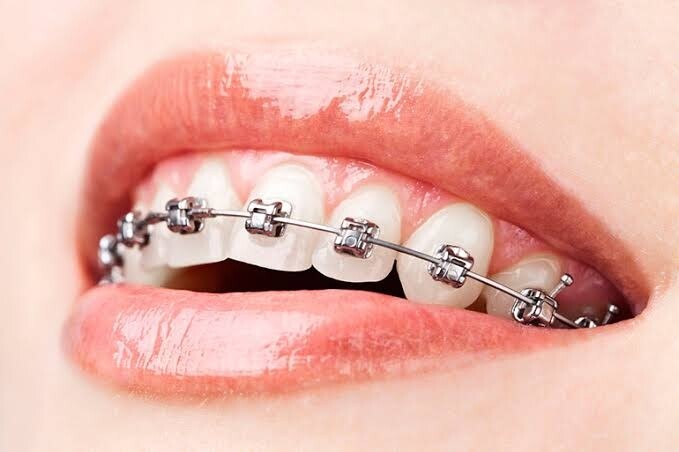 Саяногорск Инфо - Брекеты: как ухаживать за зубами и на чем заострить внимание после их установки? - teeth.jpg
