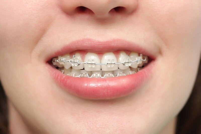 Саяногорск Инфо - Брекеты — идеальное решение для прекрасной улыбки - brackets.jpg