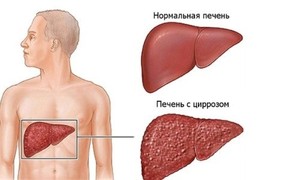 В Хакасии мать обрекла на смерть больную циррозом печени дочь