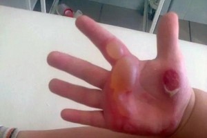 В Саяногорске проводится доследственная проверка по факту получения малолетним ребенком ожогов на детской горке